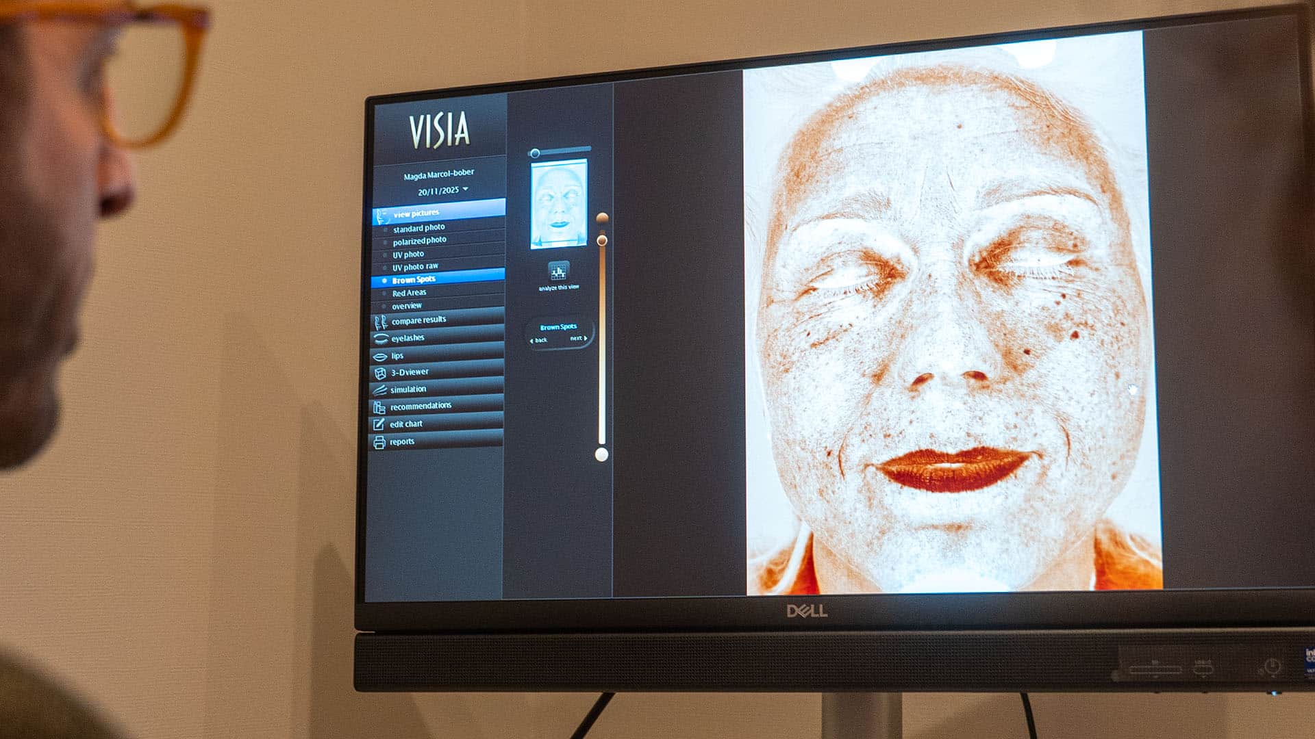 Advanced skin analysis displayed on a monitor at Cannelle Skin Clinic.