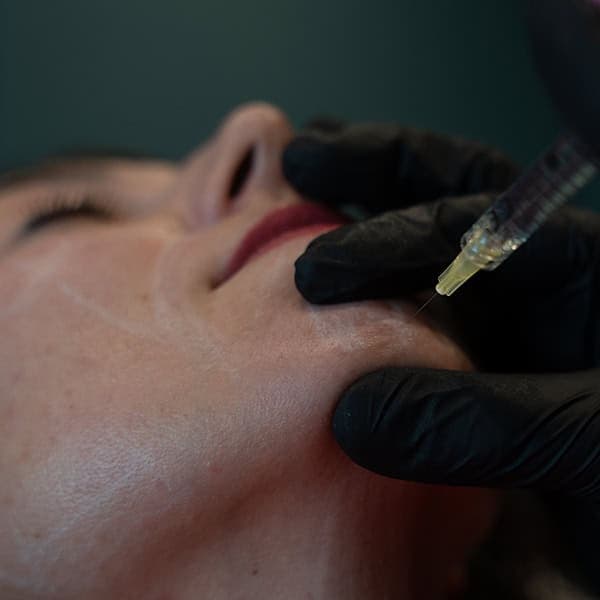 Close-up of a facial skin treatment with a syringe at Cannelle Skin Clinic.