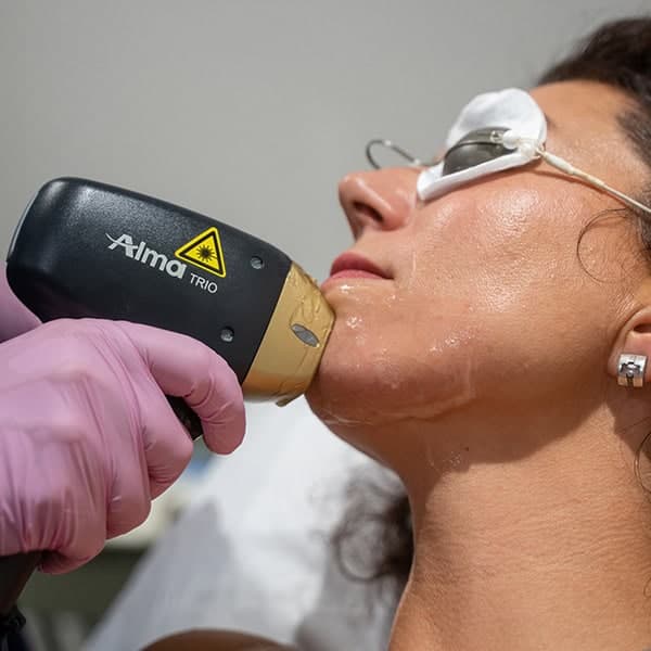 Skin rejuvenation treatment using Alma laser at Cannelle Skin Clinic.