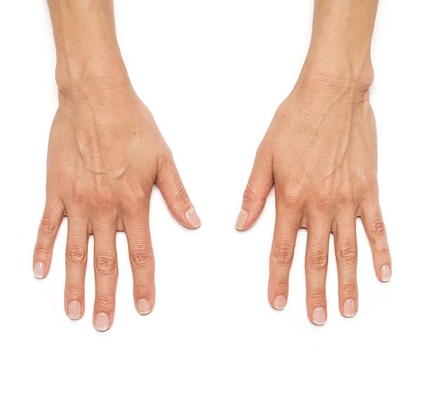 Before and after skin rejuvenation treatment on hands at Cannelle Skin Clinic.
