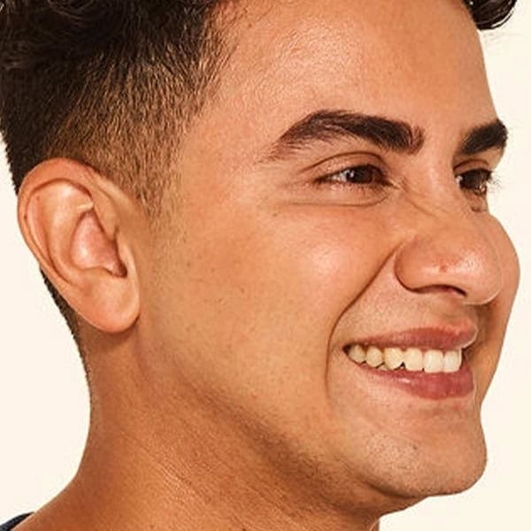 Male patient smiling after facial skin treatment, showcasing clear and healthy skin.
