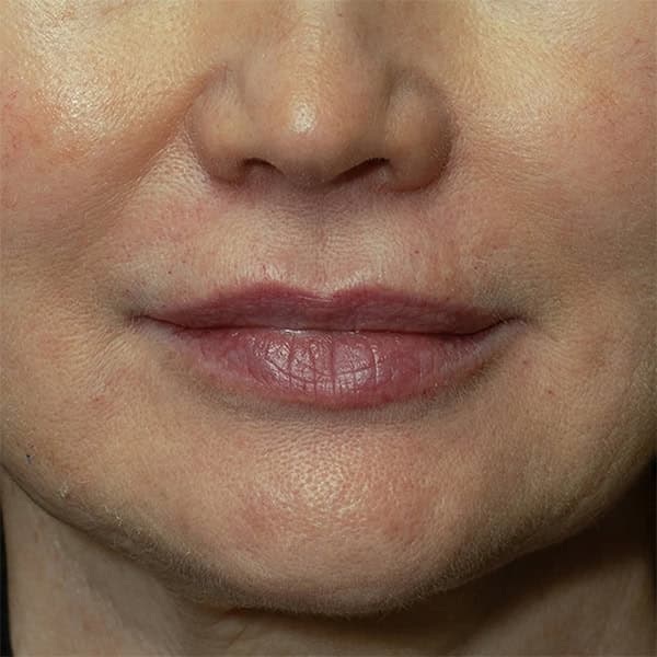 Close-up of a woman's lips and lower face after skin rejuvenation treatment.