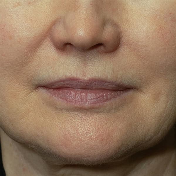 Close-up of a woman's lips and lower face showing skin rejuvenation results.