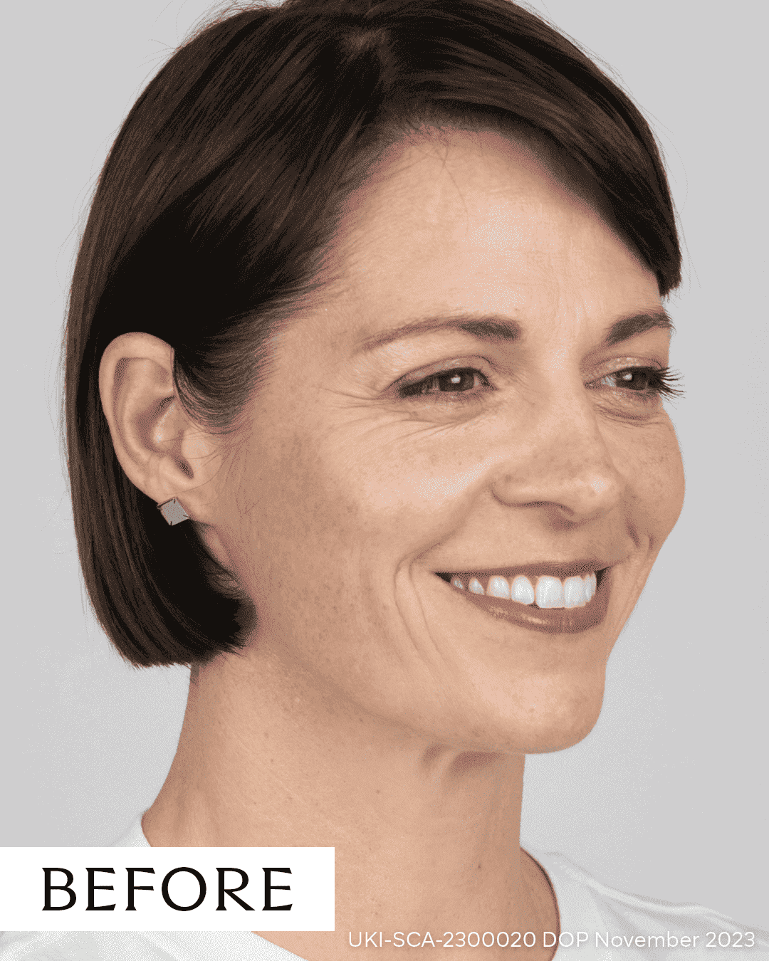 Woman with clear skin smiling, showcasing skin improvement treatment results.
