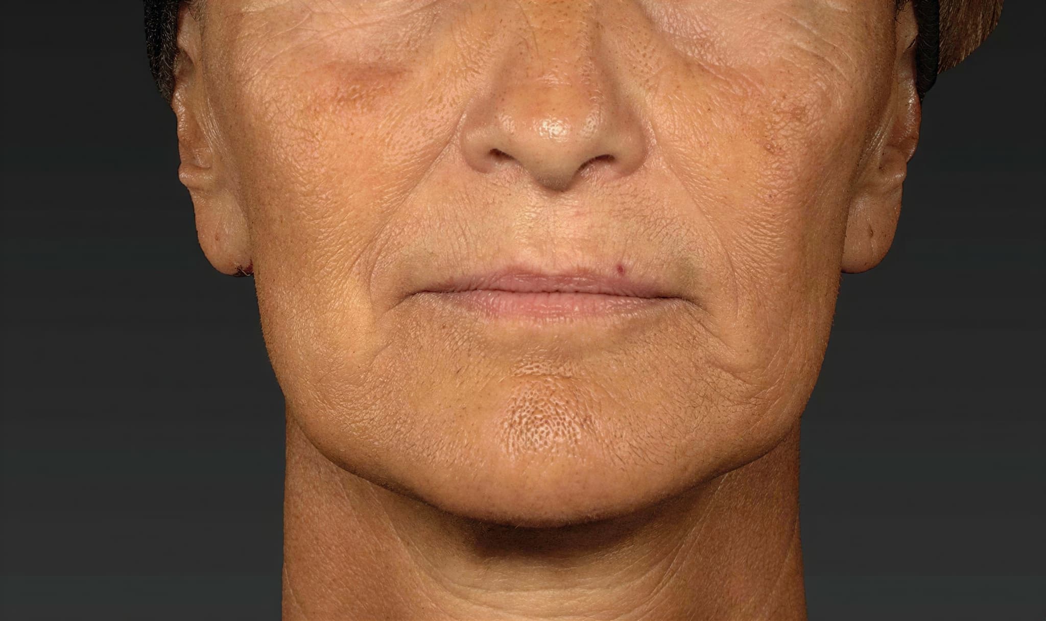 Close-up of mature woman's face showing skin texture before treatment at Cannelle Skin Clinic.