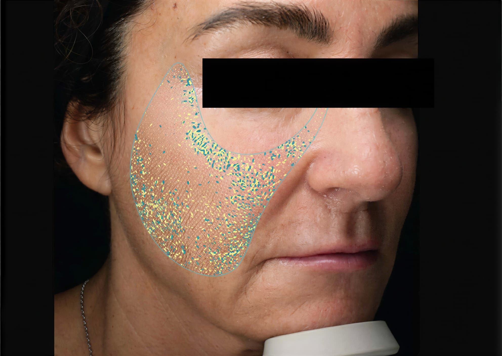 Woman receiving skin rejuvenation treatment with microdermabrasion at Cannelle Skin Clinic.