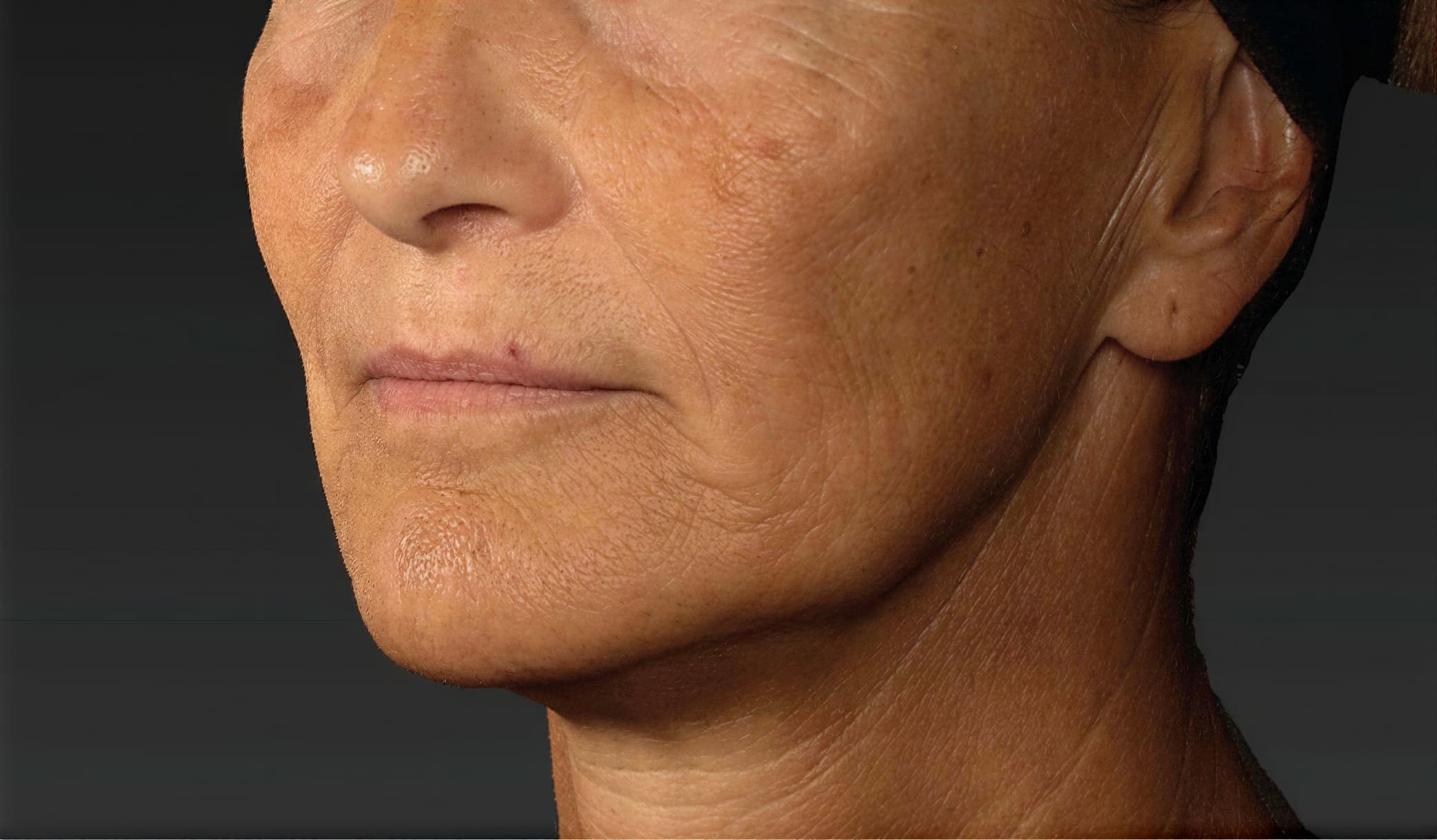 Close-up of mature woman's face showing skin improvement after treatment.