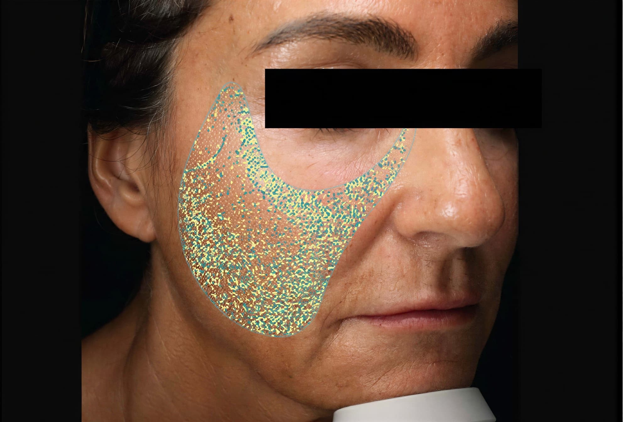 Woman receiving skin treatment with glittering facial mask at Cannelle Skin Clinic.