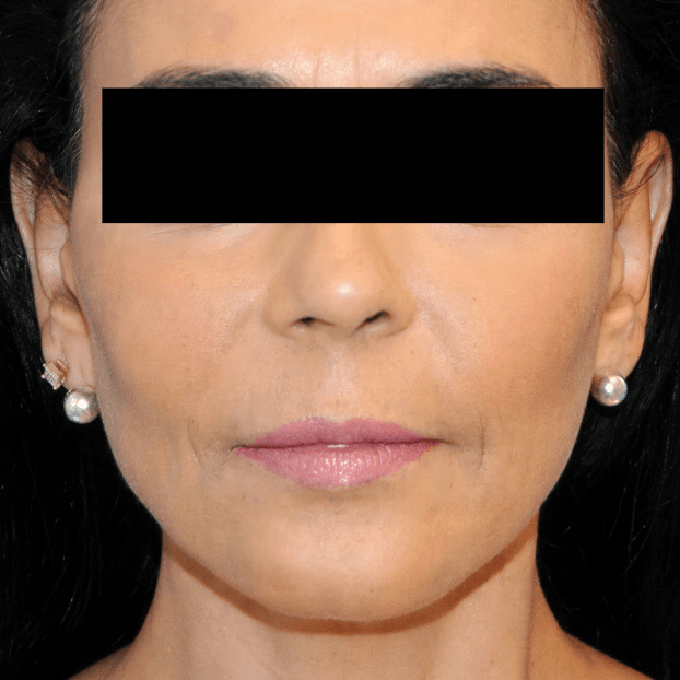 Rejuvenated woman’s face after skin treatment, showing smooth, youthful skin.