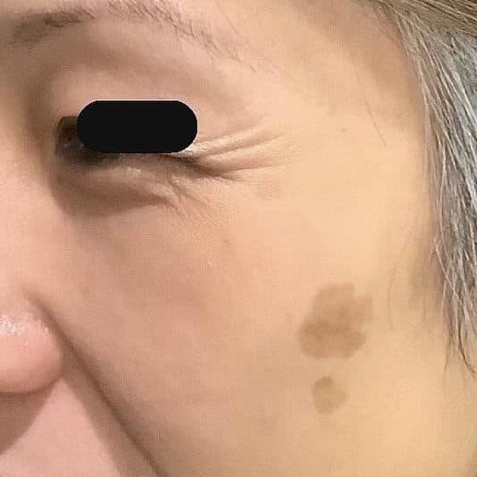 Sun damage before PicoSure laser