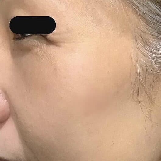 Reduced sun damage after PicoSure laser