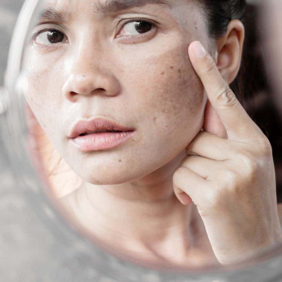 What Pigmentation Is and Why It Develops