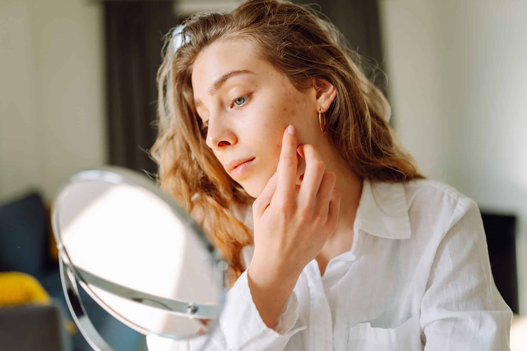 What Rosacea Is and Why It Flares
