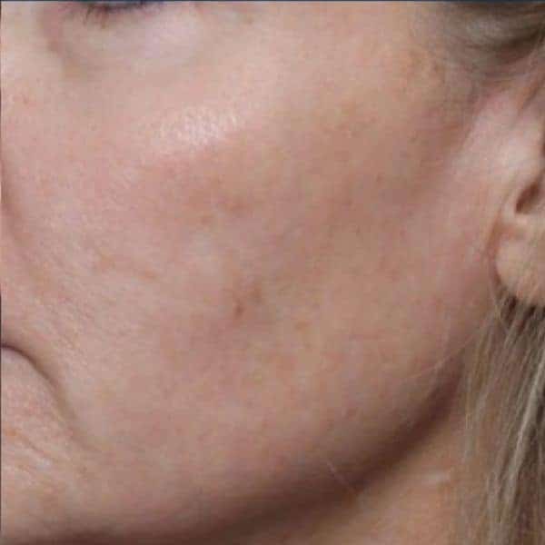 Brighter, more even skin five weeks after one 3DMIRACL session