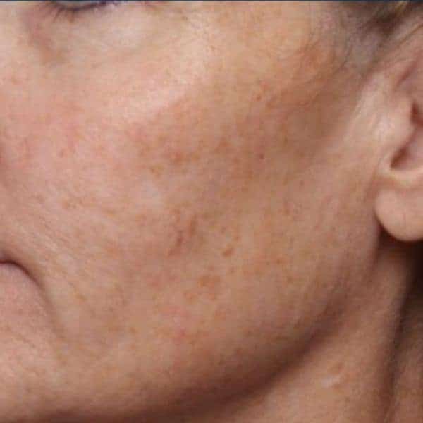 Dull, uneven skin before 3DMIRACL laser resurfacing