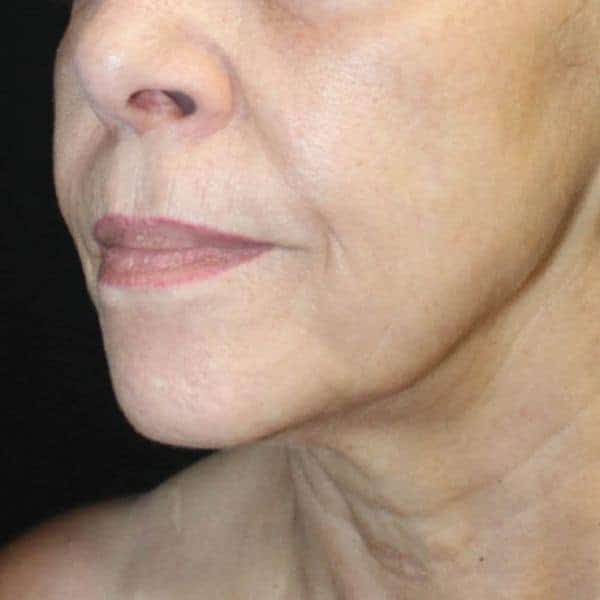 Smoother skin texture six weeks after one UltraClear laser session