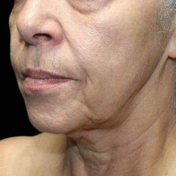 Skin texture and lines before UltraClear laser resurfacing