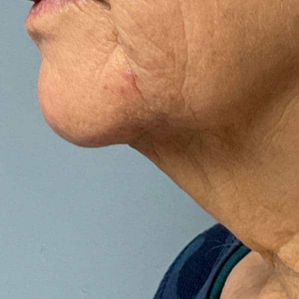 Smoother skin five months after one Laser Coring session