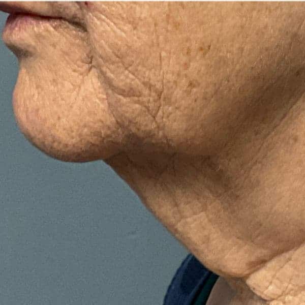 Acne scarring and skin texture before Laser Coring resurfacing