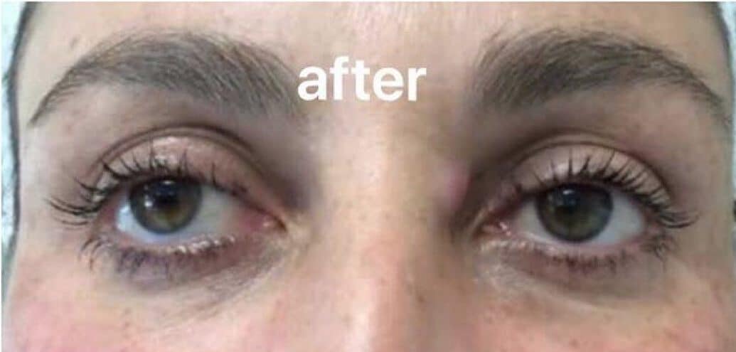 Under-eye area after dermal filler treatment
