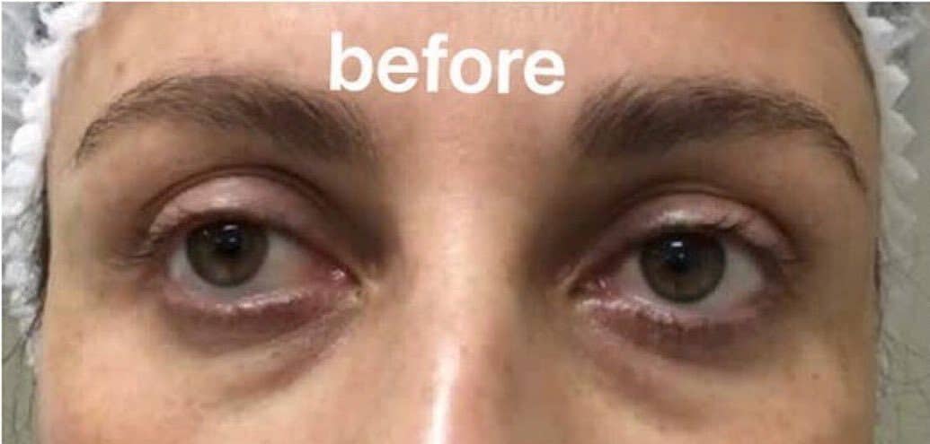 Under-eye area before dermal filler treatment