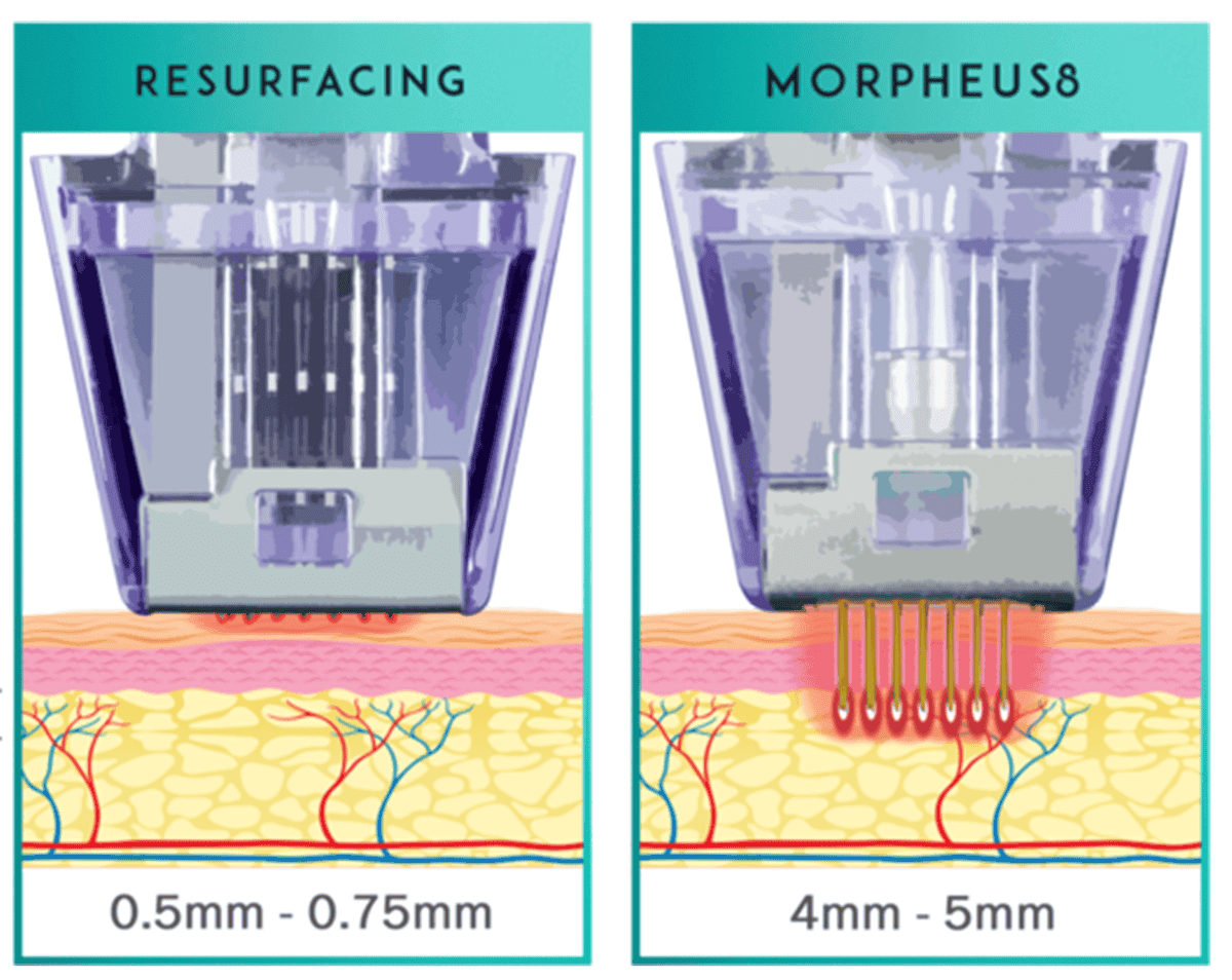 Comparison of skin resurfacing and Morpheus skin treatment devices with depth measurements.