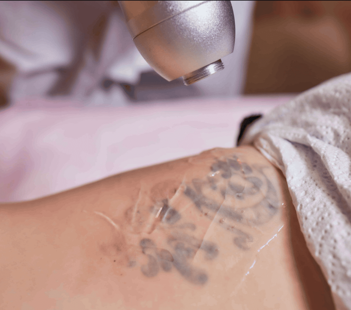 Laser skin treatment on tattooed skin at Cannelle Skin Clinic.