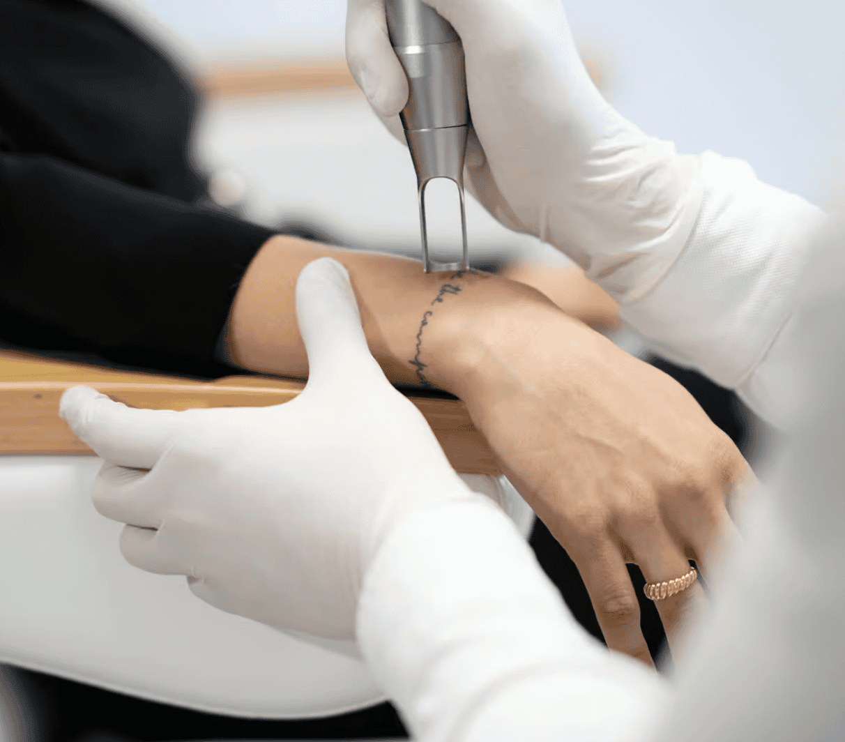 Tattoo removal treatment on forearm at Cannelle Skin Clinic, UK.