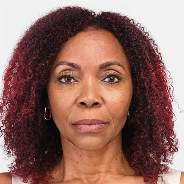 debra-front-radiesse