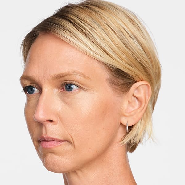 radiesse-4weeks-later