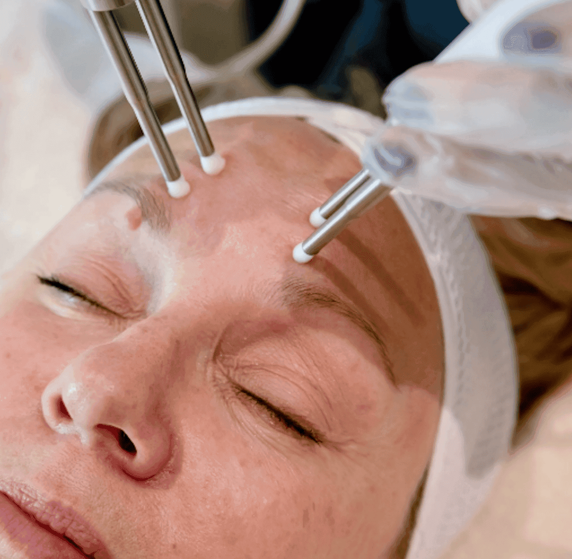 Woman receiving skin rejuvenation treatment with micro-needling devices at Cannelle Skin Clinic.
