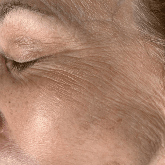 Close-up of aging skin showing fine lines and wrinkles around the eye area.