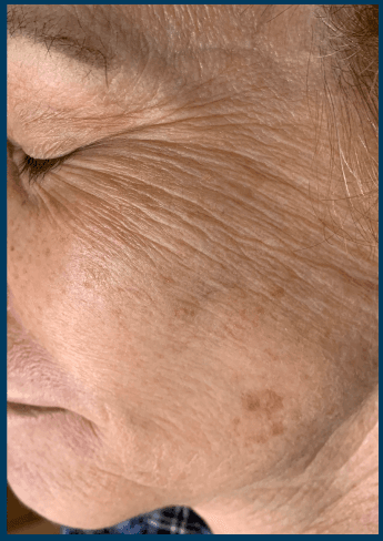 Microneedling before