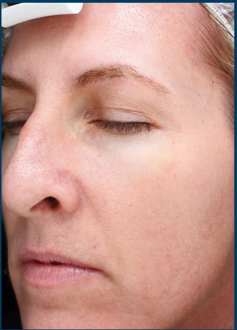 microneedling after