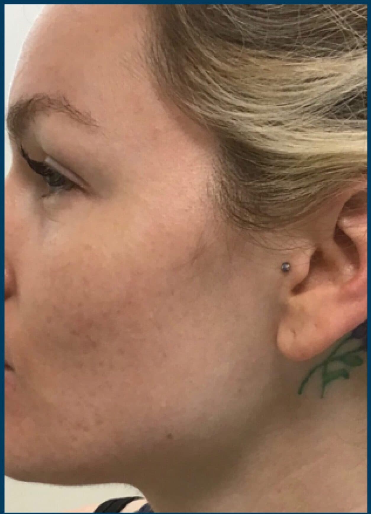 microneedling after