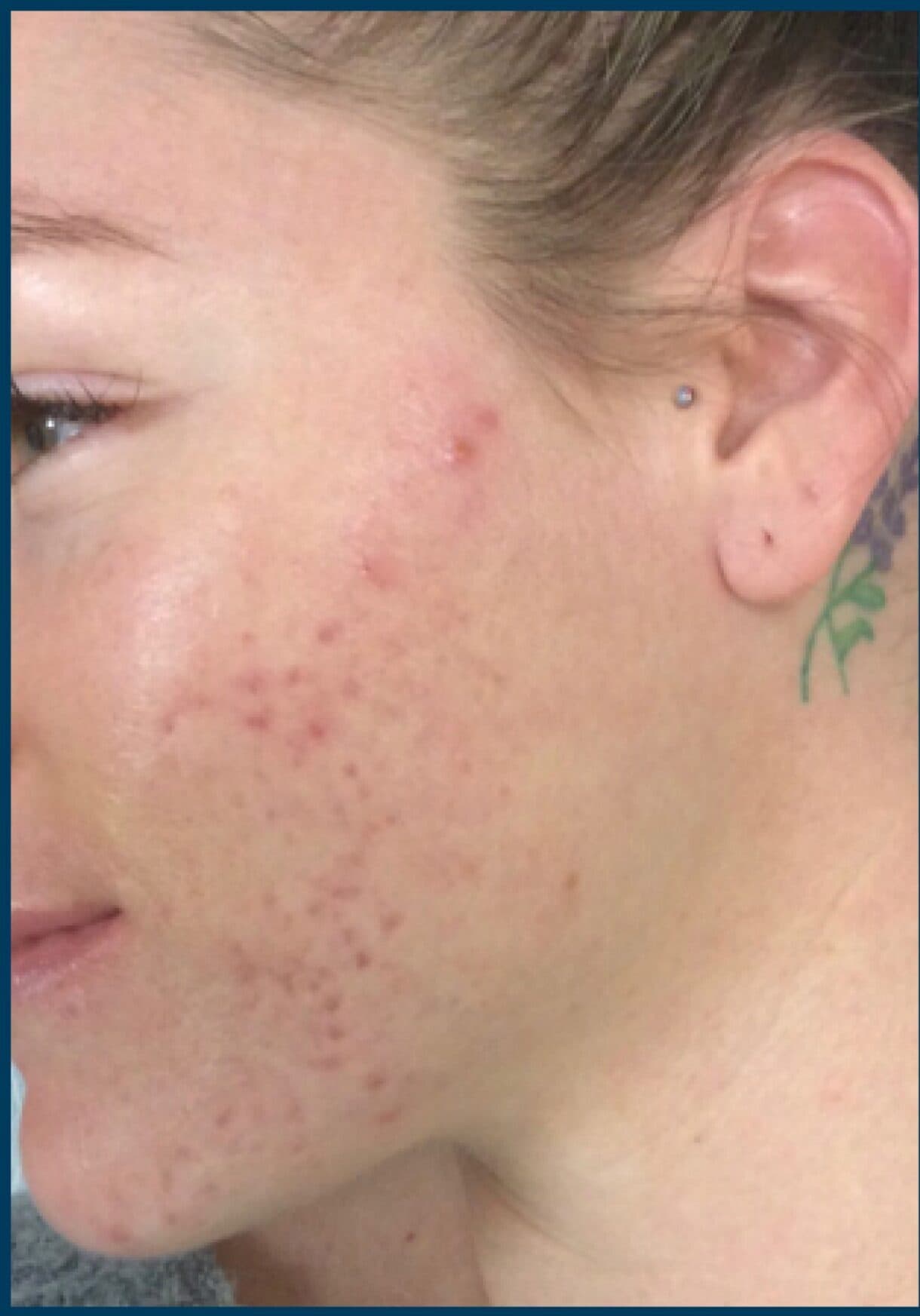 miceoneedling before