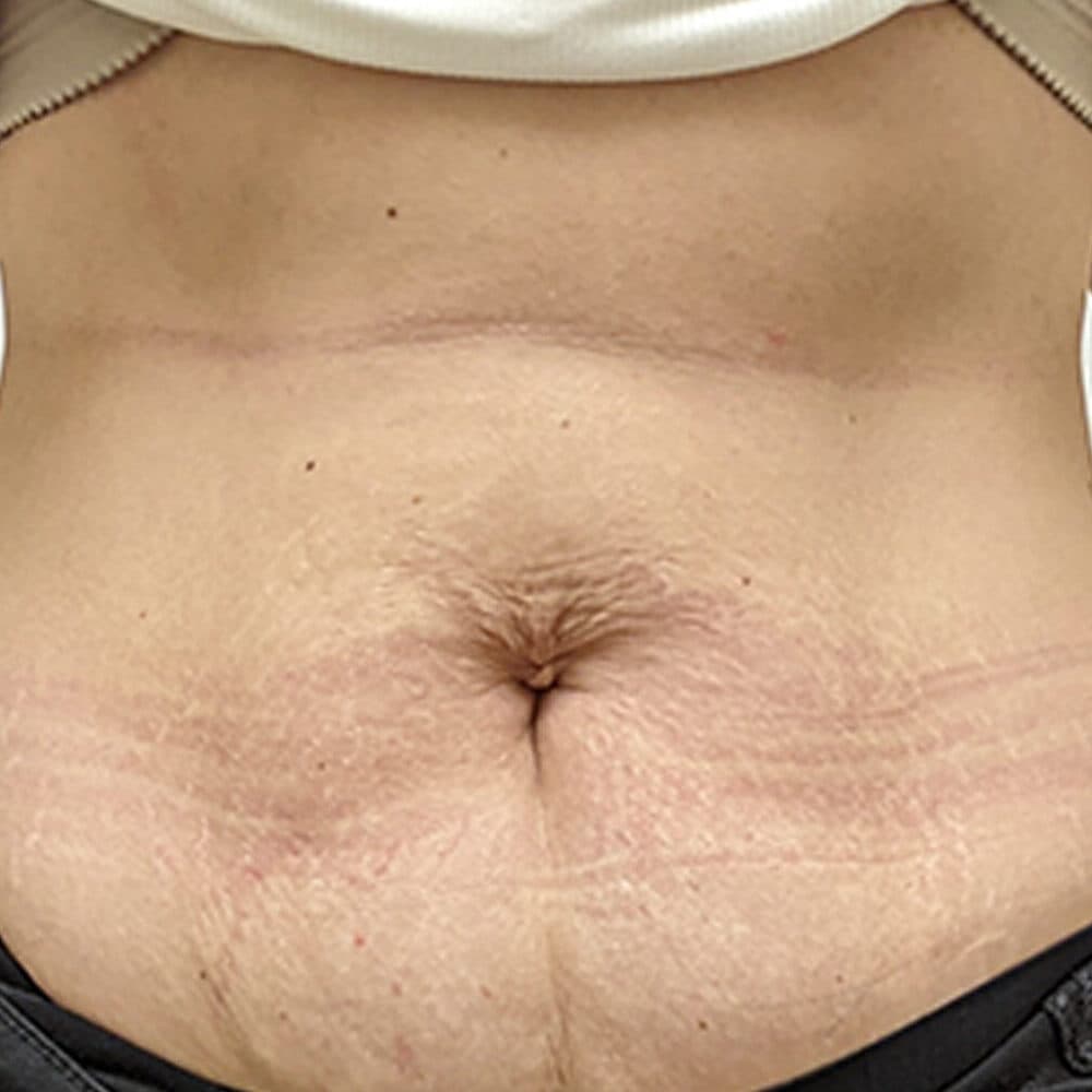 Abdominal skin with stretch marks after skin tightening treatment at Cannelle Skin Clinic.
