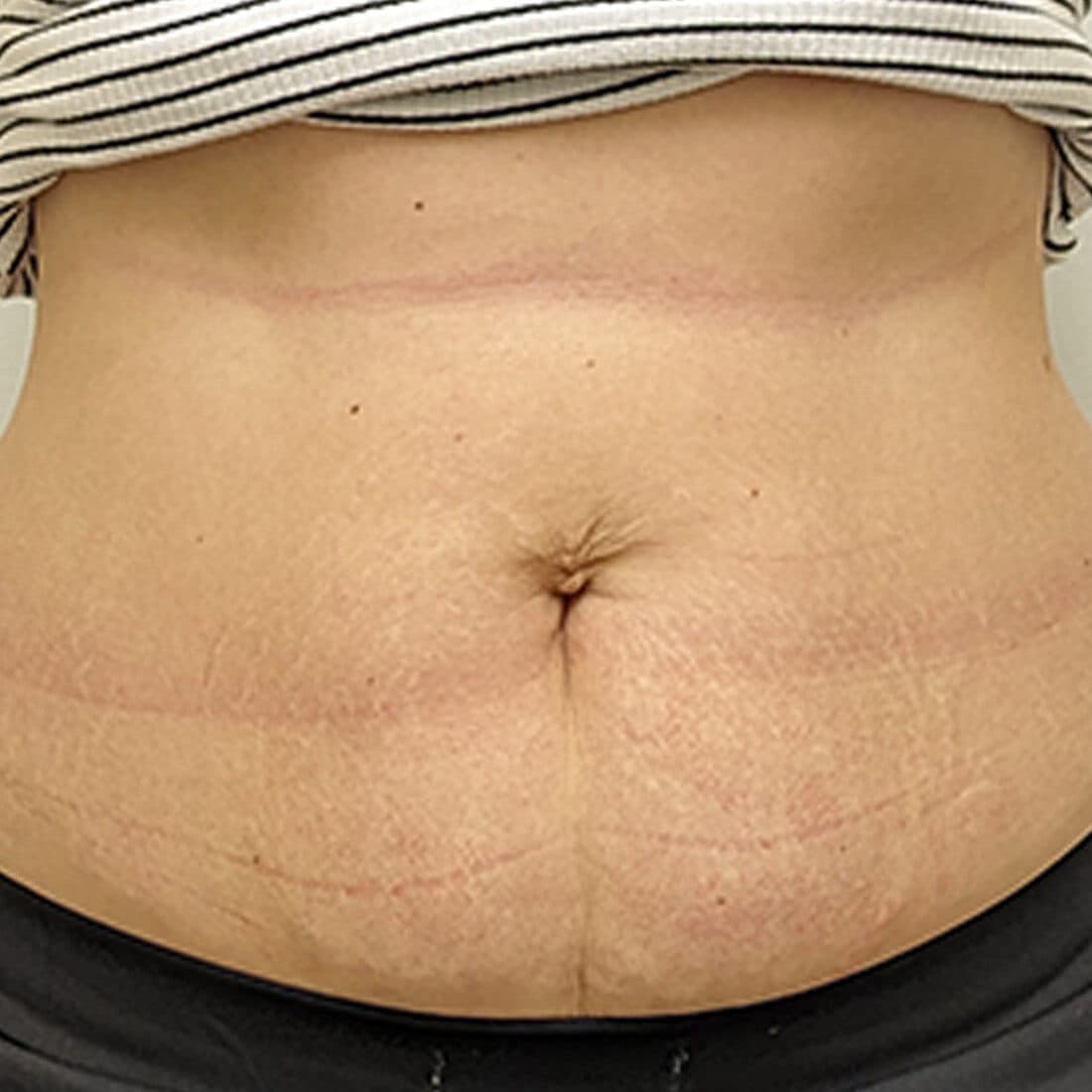 Close-up of a woman's abdomen showing skin tightening and stretch mark reduction after treatment.
