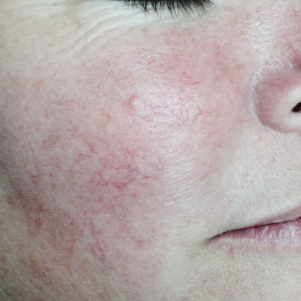 Red skin and visible irritation on a person's cheek, indicating skin sensitivity or rosacea.