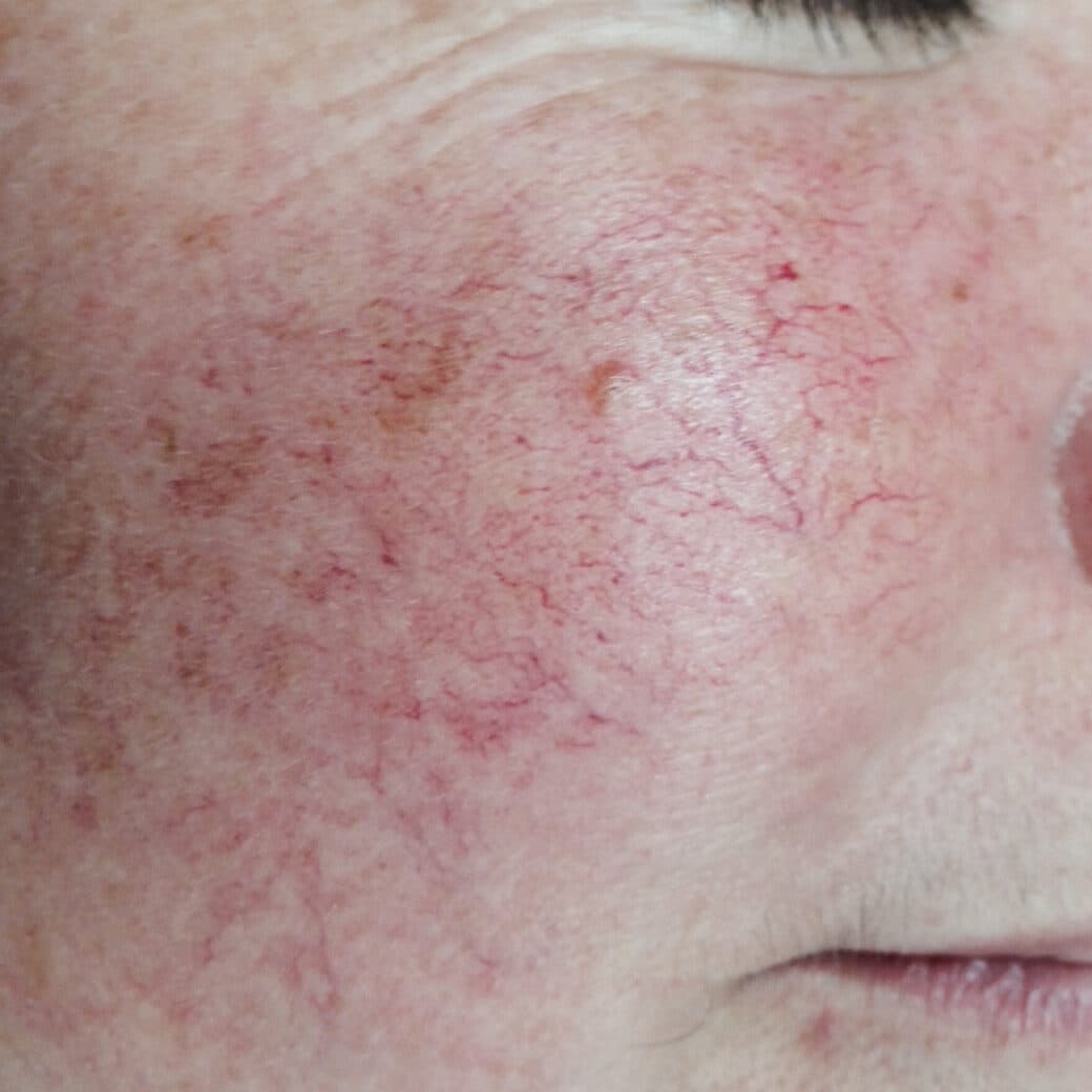 Visible facial redness and broken blood vessels on cheek.