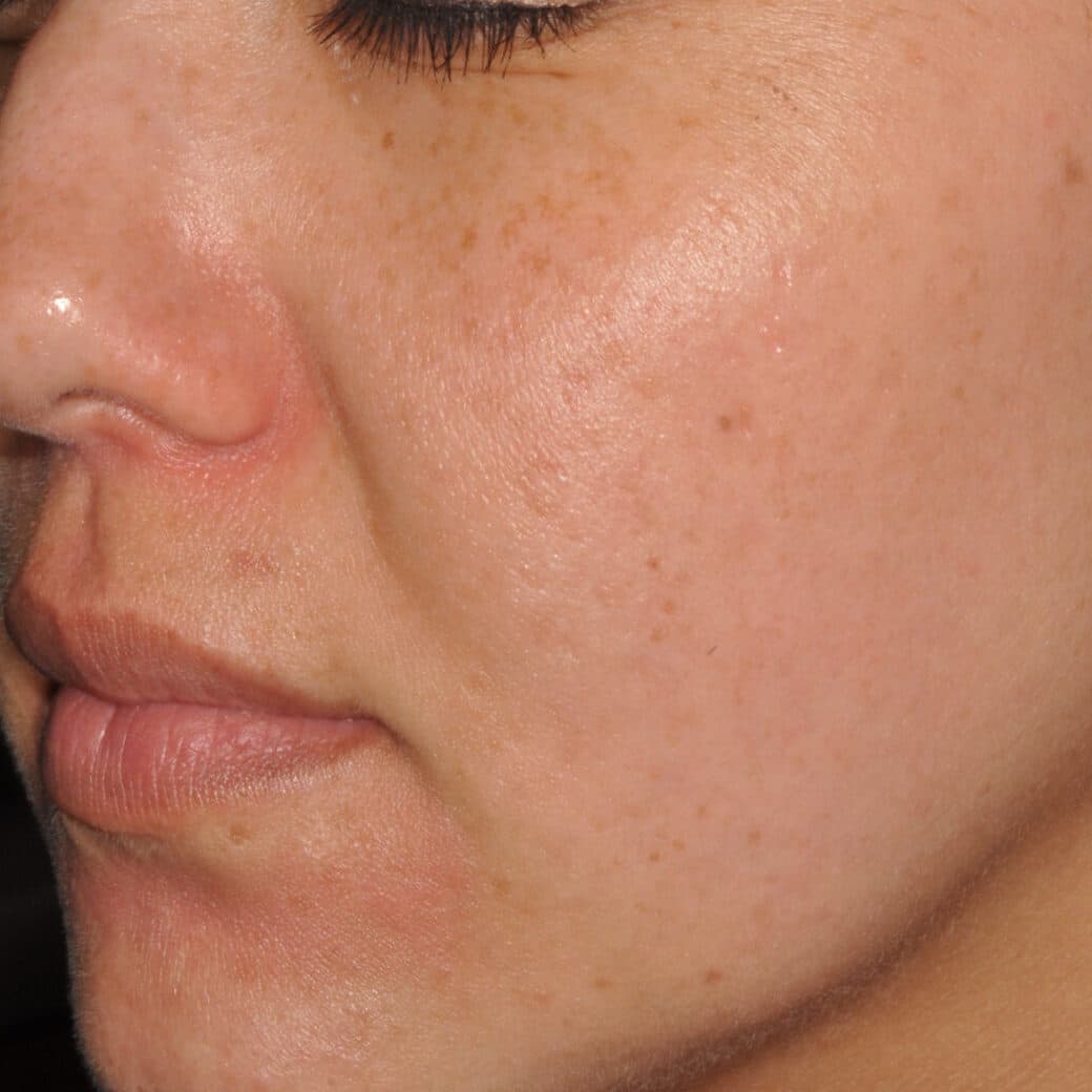 Close-up of clear, smooth skin after treatment at Cannelle Skin Clinic.