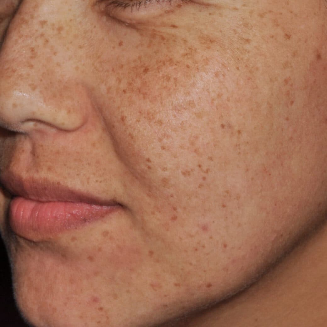 Hyperpigmentation and sun damage treatment at Cannelle Skin Clinic, promoting clearer, healthier ski.