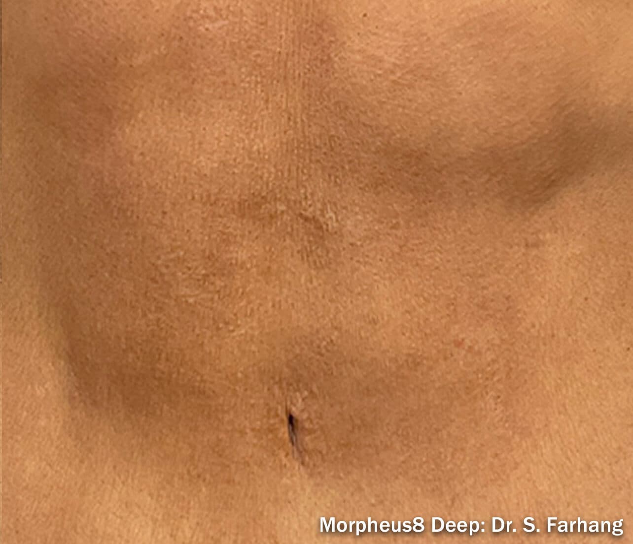 Morpheus 8 body after