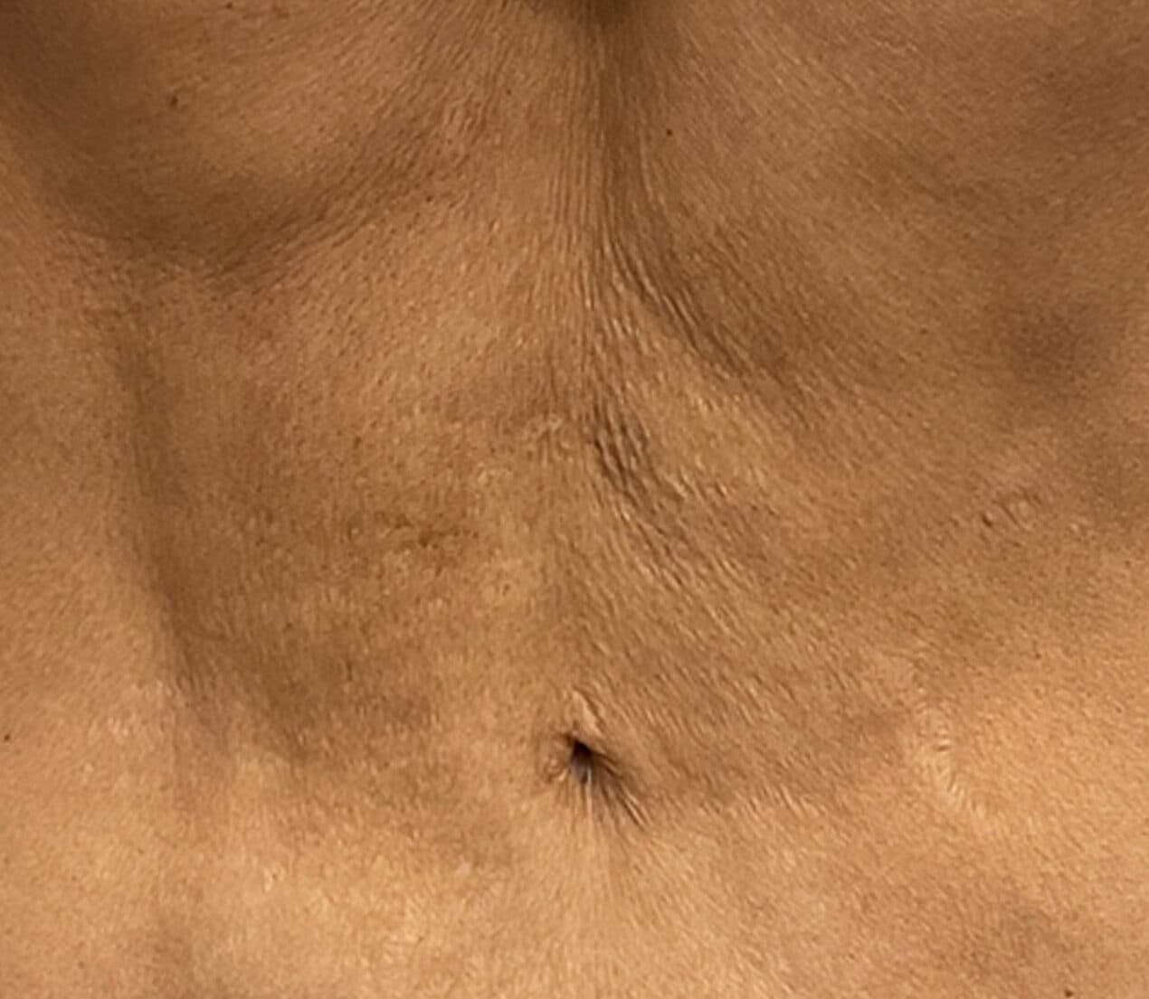 Morpheus 8 body before