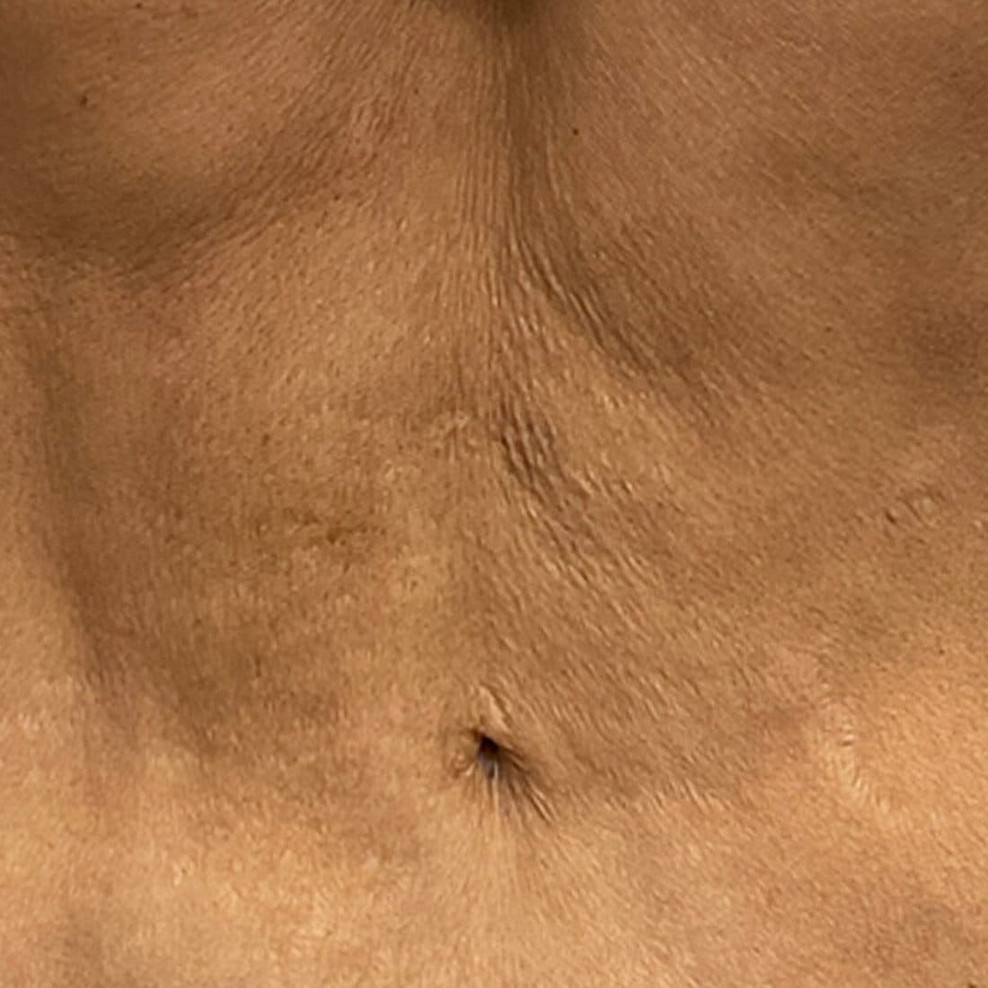 Close-up of skin showing signs of aging and loose skin, highlighting the need for skin tightening so.