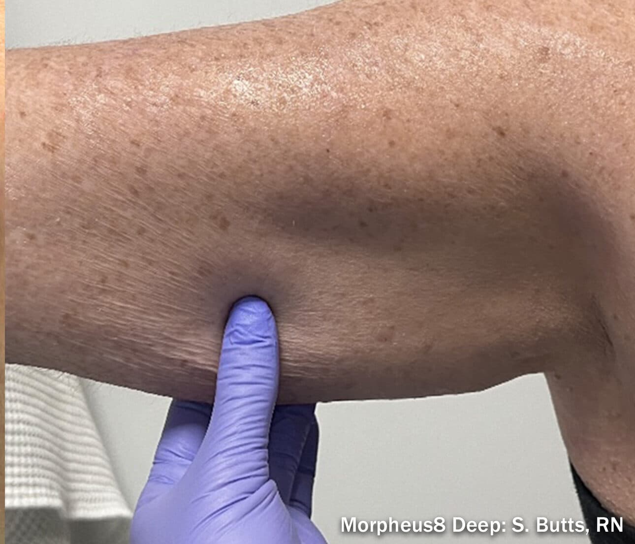 Morpheus 8 body after