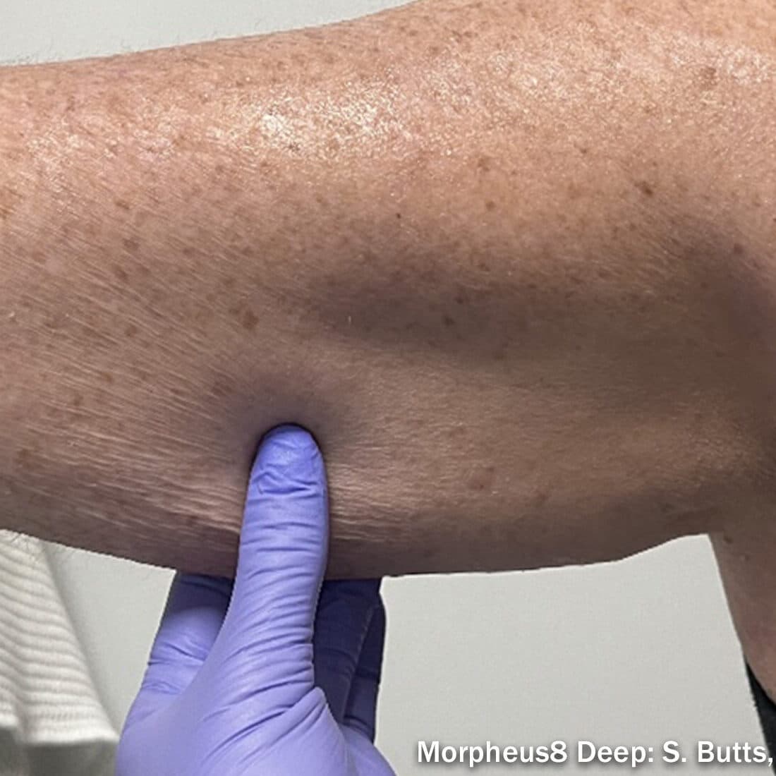 Deep skin analysis for effective skin rejuvenation and pigmentation treatment.