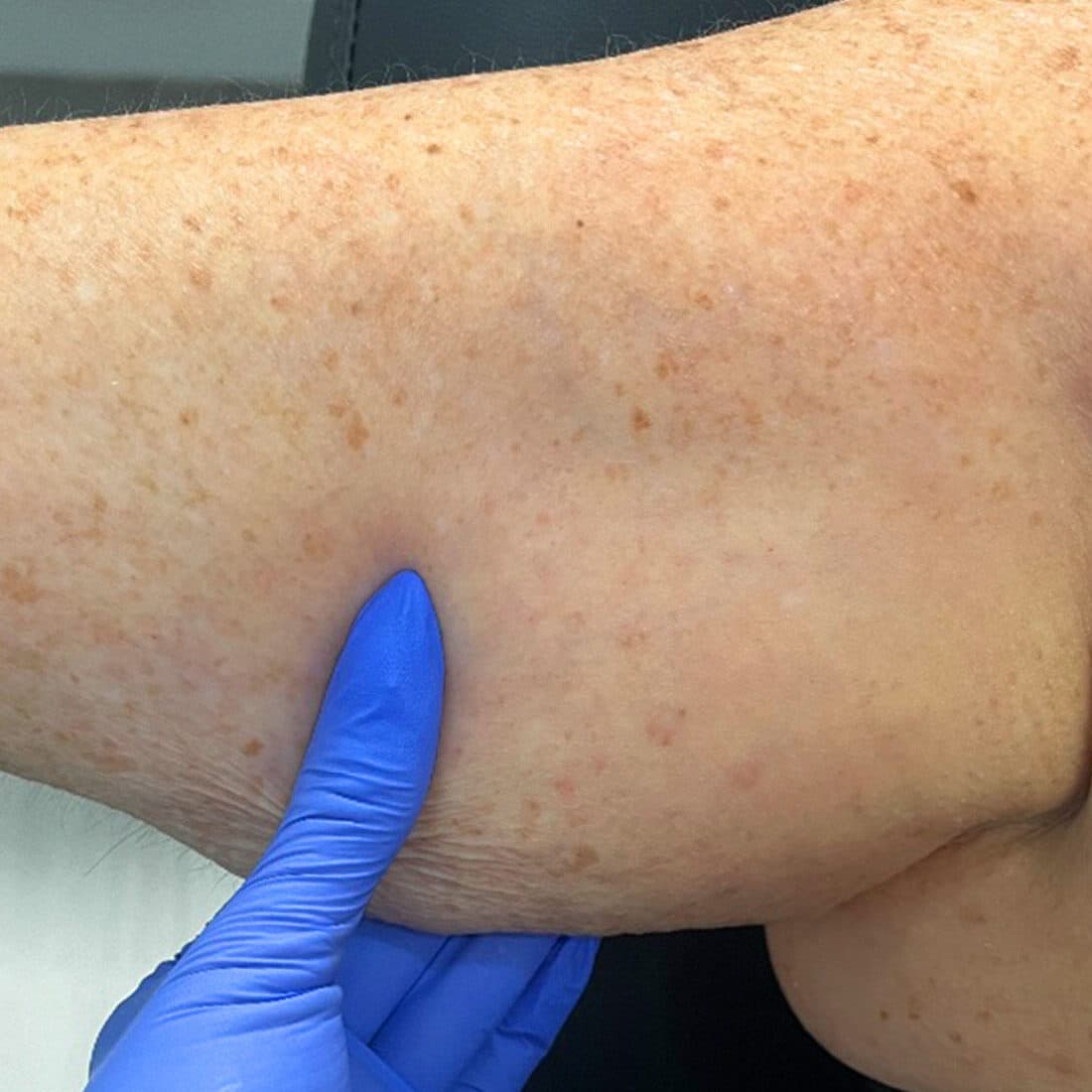 Skin analysis showing pigmentation and texture concerns.