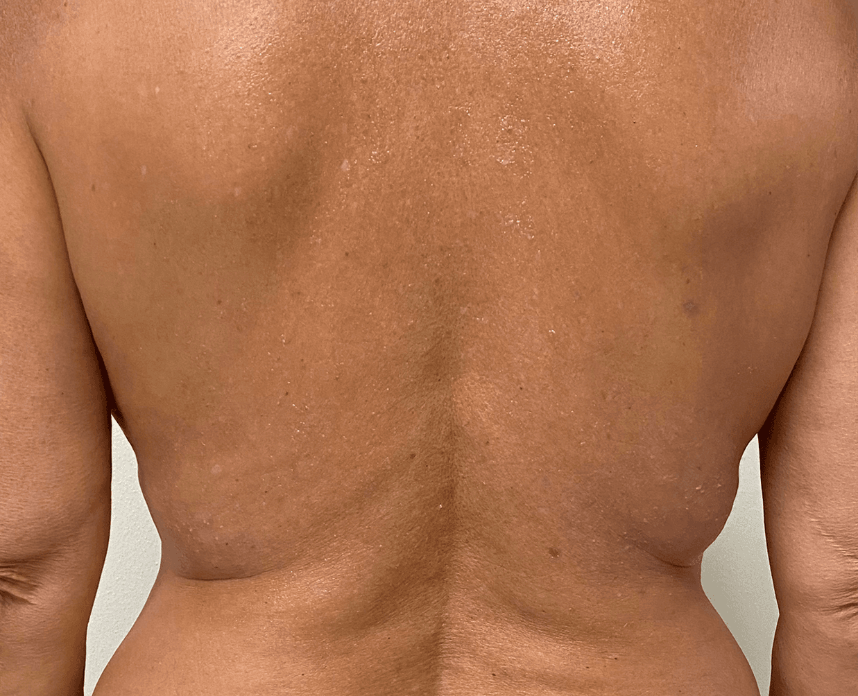 Morpheus 8 body after