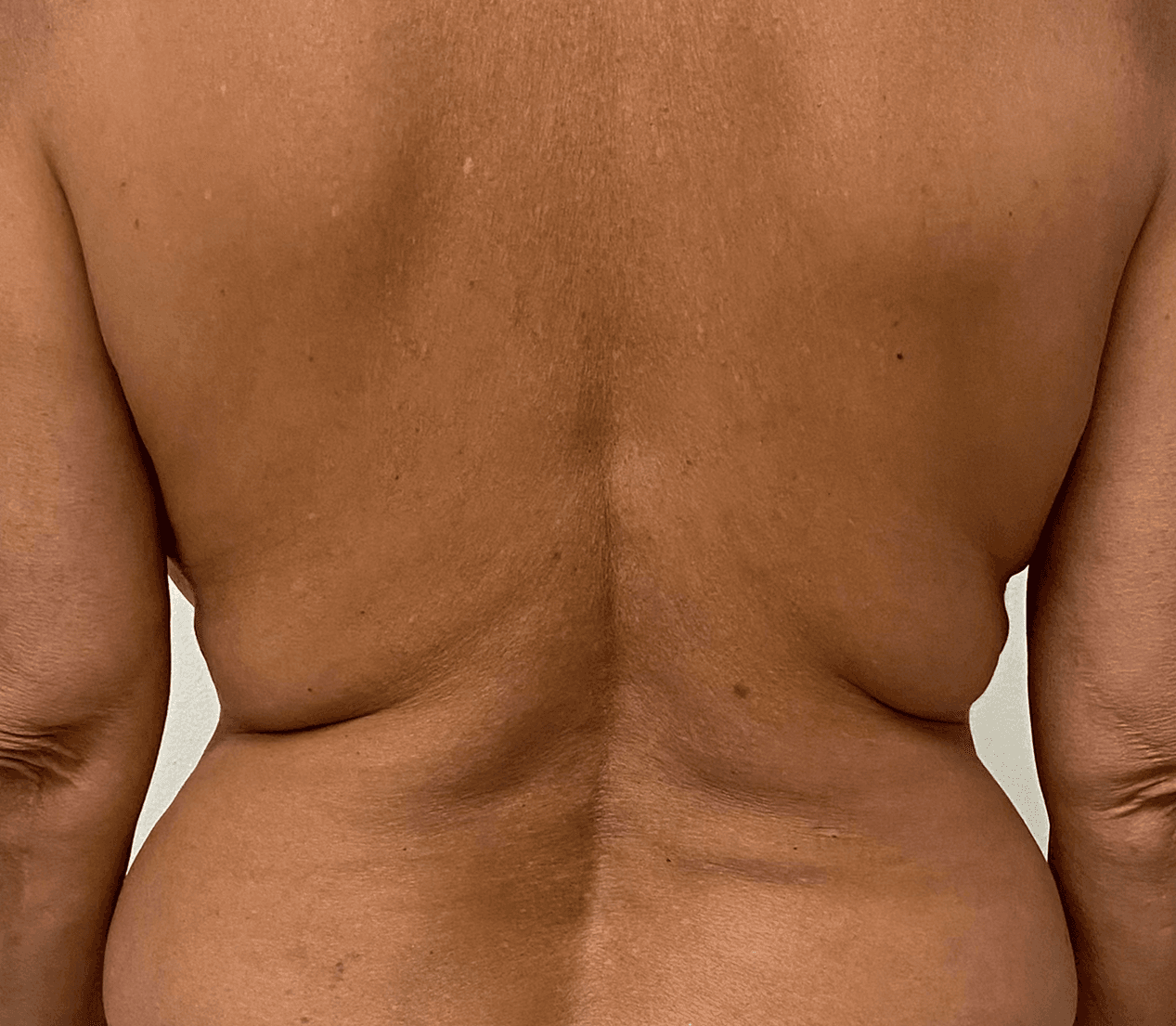 Morpheus 8 body befre